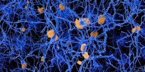 Amyloid-Ablagerungen